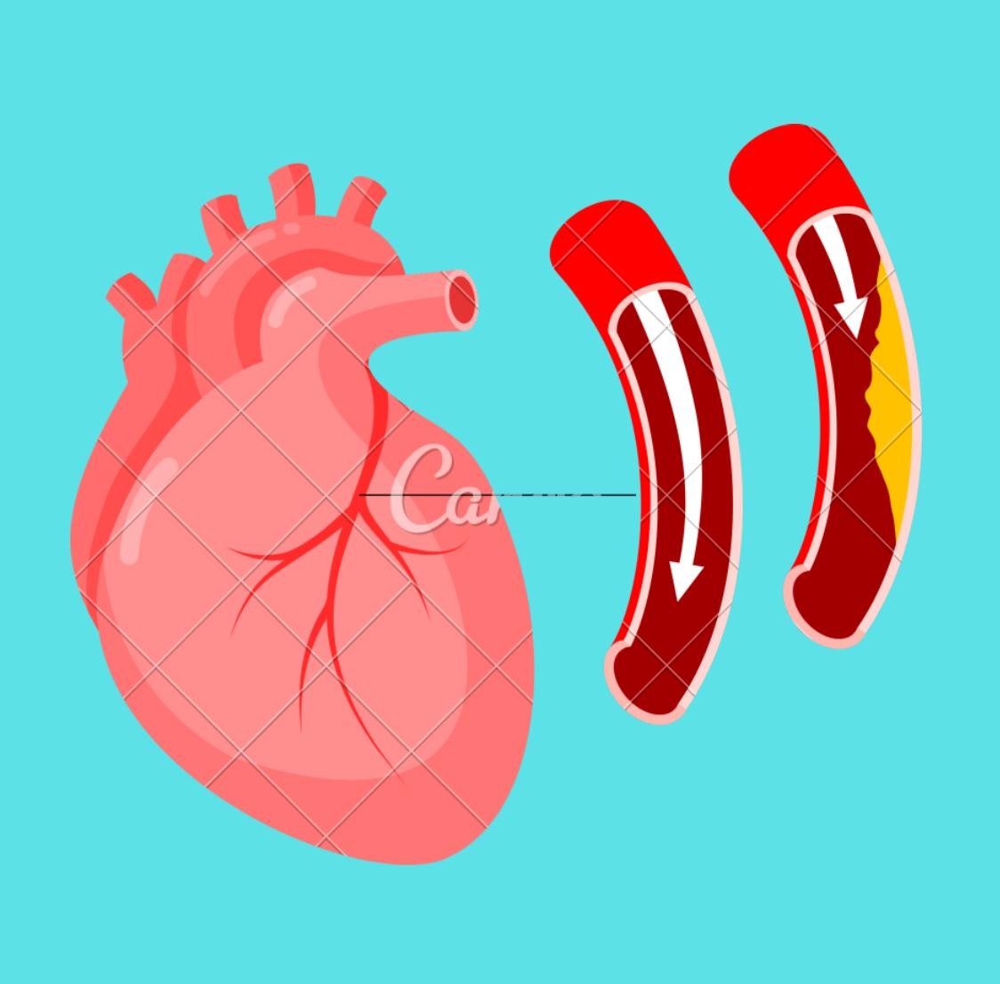 Low Density Lipoprotein - LDL